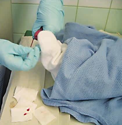 A B Figur 1. Screeningprovet tas från sidan av bebisens häl (A). Ett helblodsprov pipetteras på ett läskpapperskort (B). Närmare anvisningar finns på webbplatsen www.saske.fi. vårdprofessionella behöver information.