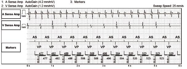 ter av patienter med pacemaker eller ICD [9, 10].