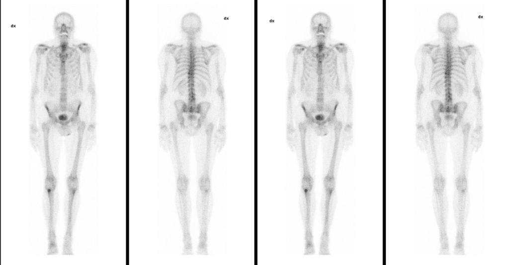 Skelettscintigrafi ( 99 Tcm): Utlåtande: Ordinärt upptag av radionukliden, intet metastassuspekt. DT thorax med iv kontrast och peroral kontrast: Inga lungparenkymförändringar, intet metastassuspekt.