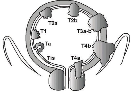2017 TNM classification of urinary bladder cancer T - Primary tumour TX T0 Ta Tis T1 T2 T3 T4 N - Regional lymph nodes NX N0 N1 N2 N3 Primary tumour cannot be assessed No evidence of primary tumour