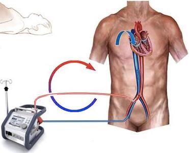 Indikationer för ECMO idag Hjärtsvikt Lungsvikt - post thoraxkirurgi - ARDS - post hjärttransplantation - pneumoni/sepsis - kardiogen chock - trauma