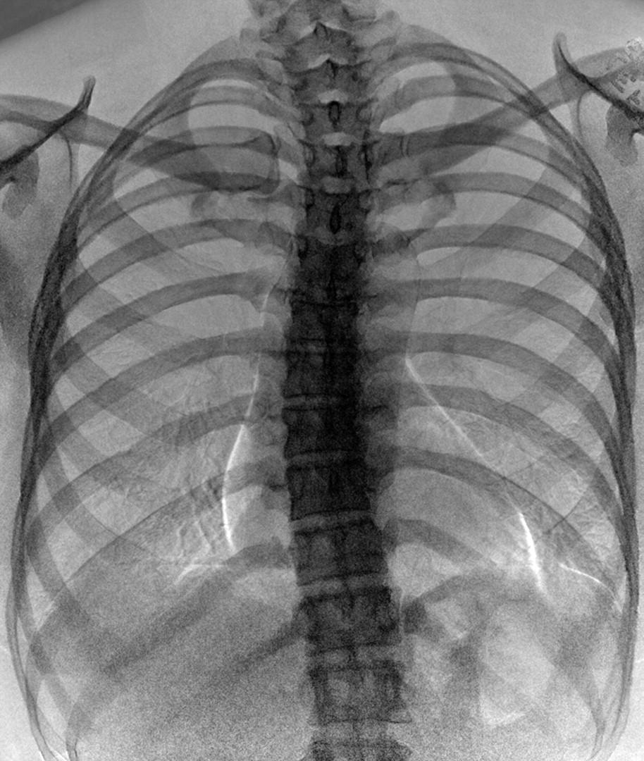 Note improved depiction of vascular anatomy in b. 2006 by Radiological Society of North America McAdams H P et al.
