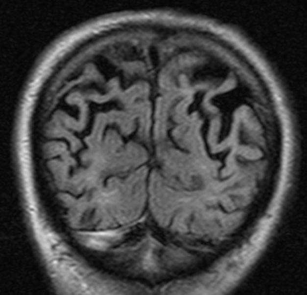 Posterior kortikal atrofi (PCA) Parietalt