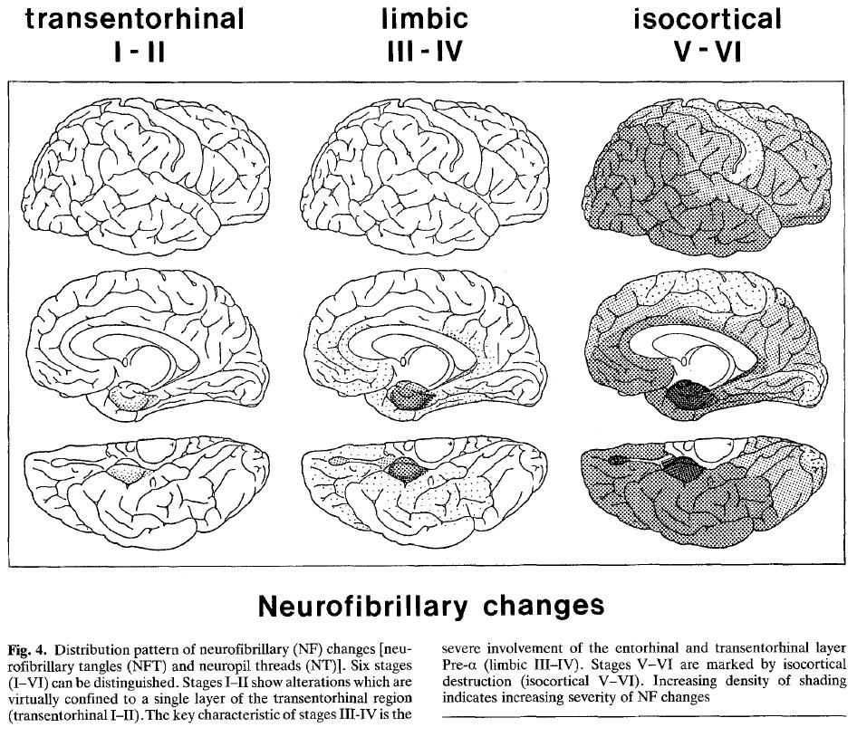 (amyloid plaque) Neurofibrillärt