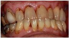 ohälsa Påminn om att munhälsan är viktig Uppmuntra fortsatt kontakt med tandvården Viktigt med