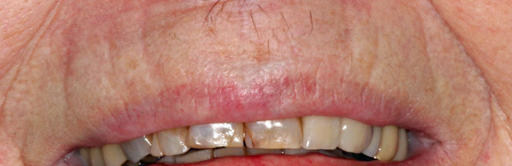 tänder högt upp i åren Många har implantat, kronor eller broar Risken för skador ökar