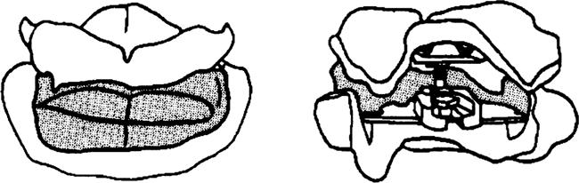 ANVÄNDNING För att fixera denna käkrelation: Dra fast kulskålens insexskruv framifrån med kombinationsnyckeln [9]. 9 6.5 Förberedelser för transport Ta bort registratet ur patientens mun.