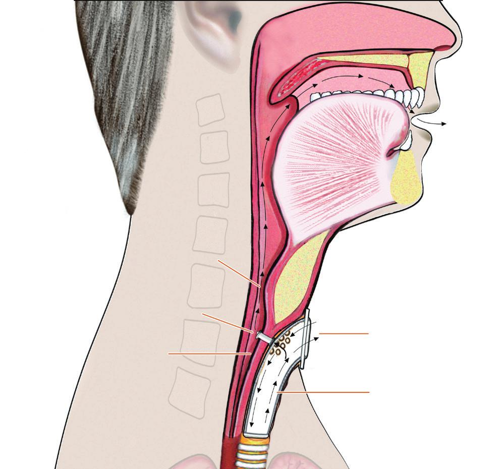 ANATOMI BEFORE THE LARYNGECTOMY/TRACHEOSTOMY AFTER THE TRACHEOSTOMY VOICE VOICE LARYNX VOCAL FOLDS VOCAL FOLDS OESOPHAGUS TRACHEA OESOPHAGUS SPEAKING VALVE AIRFLOW FROM AND TO LUNGS TRACHEOSTOMY TUBE