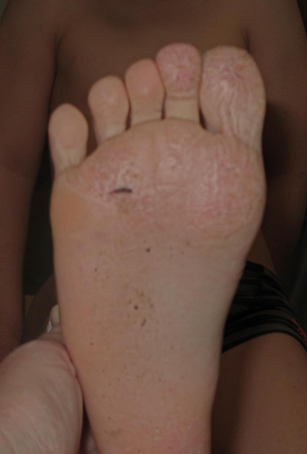 ATOPISKA VINTERFÖTTER Juvenil plantar