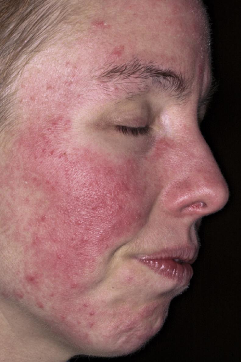 Rosacea