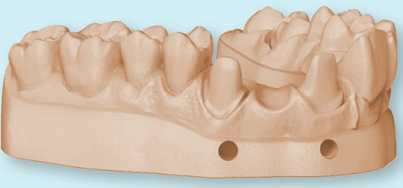max ZirCAD Prime 10 % rabatt hela november december Nu får du 10 % rabatt när du väljer att fräsa i Ivoclars senaste material ZirCAD