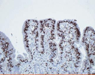Fråga 53 (1p). På bilden nedan har CD3-färgning gjorts (Fig. 2). Vad är syftet med detta och hur tolkar du bilden? Fig. 2. Biopsierna från duodenum visar slemhinna med förändringar; Marsh IIIc.