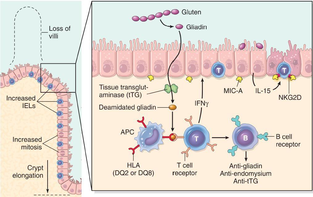 Svar 54 (3p). Inflammationsmekanismerna vid celiaki beskrivs schematiskt i bilden nedan.