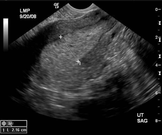 Du undersöker Karin och finner atrofiska slemhinnor i vagina. Liten mängd blodtillblandad flytning. Portio/cervix ua. Du tar ett cytologprov. Helt normala palpationsfynd.