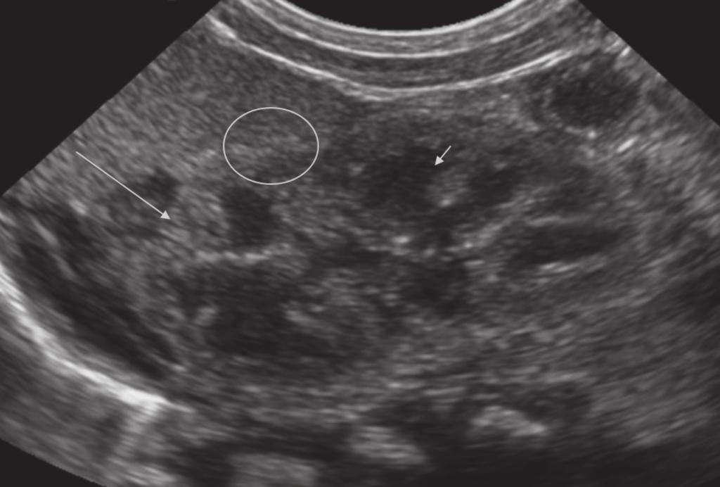 New Perspectives on Imaging of Urinary Tract Infections in Infants US is currently the most commonly used imaging method for assessing the kidneys and the urinary tract in children.