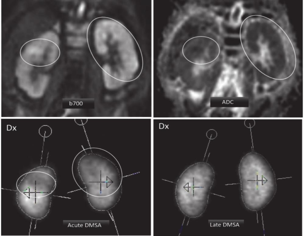 New Perspectives on Imaging of Urinary Tract Infections in Infants Pyelonephritis was diagnosed in 8 (16%) of the 50 kidneys on DWI compared with 12 (24%) on the DMSA scans and 9 (18%) using