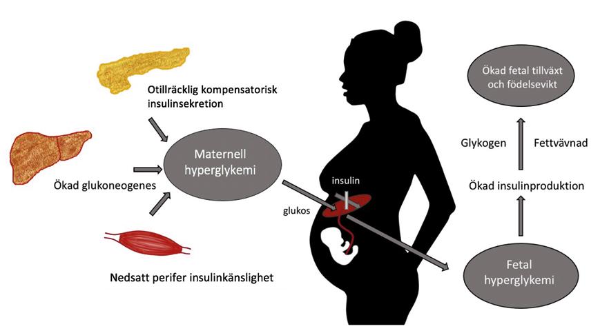 Figur 1. Patofysiologin bakom graviditetsdiabetes och fetal makrosomi (11, 23). ningsskador och igångsatta eller för tidiga förlossningar (<37 graviditetsveckor) (4, 21) (tabell 4).