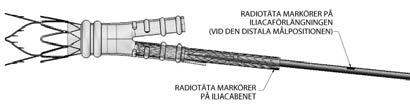 5 Under det att ledarens position bibehålls, avlägsna angiografikatetern och införarhylsan från ingångspunkten (om tillämpligt). 6 Placera införingssystemet för iliacaförlängningen över ledaren.