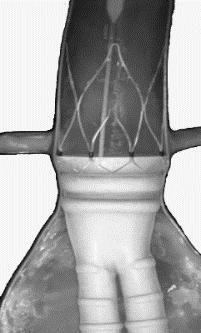 Figur 2. TriVascular aortakroppsstentgraft i aorta 1.