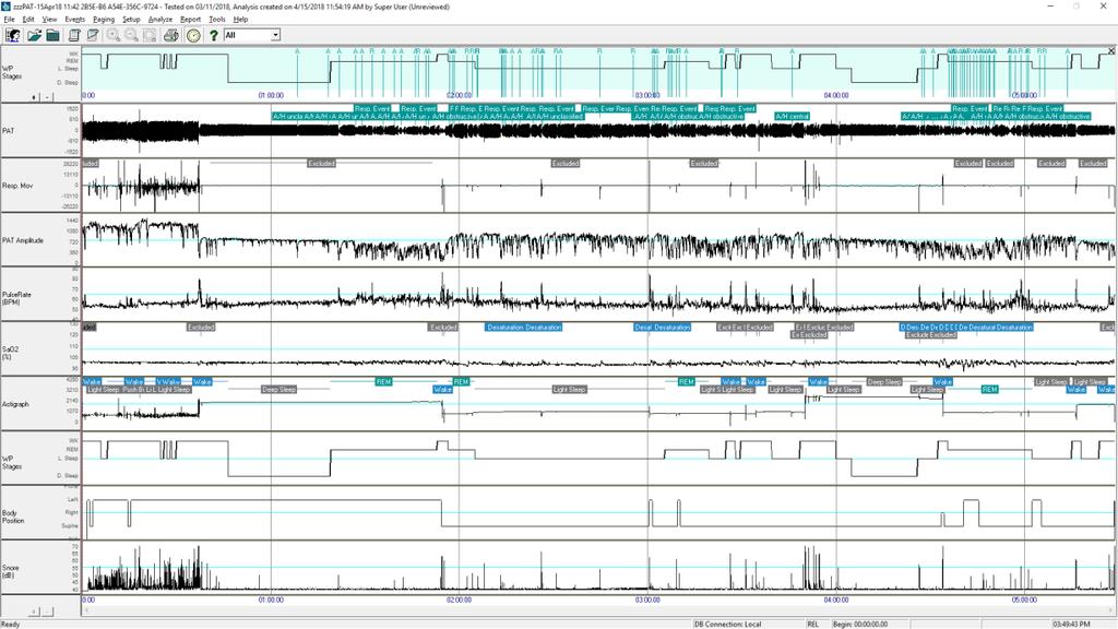 Figur 3 En typisk skärm för zzzpat:s analysprogram 2.2 Beskrivning av fingersonden WatchPAT:s fingersond är en elektro-opto-pneumatisk fingermonterad sond.