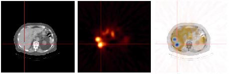 Positronkameraundersökning (PET) av patient med elakartad tumör med flera metastaser (dottersvulster) i levern. Bilderna är tagna med s k kombinationskamera.