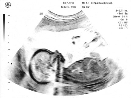 Om fostret har ett ryggmärgsbråck eller ett bukväggsbråck kan detta också upptäckas relativt lätt med hjälp av ultraljud.