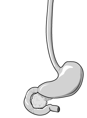 Vårdriktlinjer vid gastroesofageal refluxsjukdom Sammanfattning 3 Definitioner 4 Epidemiologi 4
