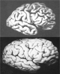 Mini-Mental test (MMSE) Nervcellerna dör Nervimpulserna kan inte fortledas Leder till förlust av intellektuella och fysiska funktioner Vad är demens? Vad innebär det att vara demenssjuk?