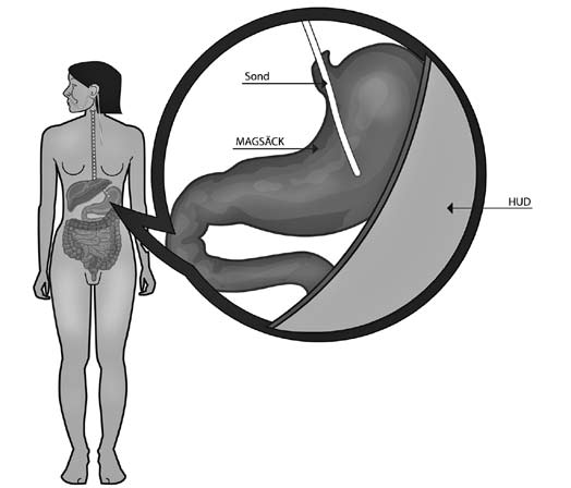Figur 1. Placering av nasogastrisk sond (a) och perkutan endoskopisk gastrostomi (b). a) b) Illustration: Linda Skogfeldt. Tabell I. Enterala infarter.