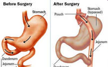 4 OPERATIONSMETODER (SoReg 38 kliniker) Gastric bypass (GBP) Vertical banded gastroplasty (VBG) Gastric banding (GB) Biliopancreatic diversion med Duodenal sw itch BPD Biliopancreatic diversion enl