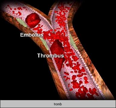 Plackruptur/erosion Trombocyter samlas vid