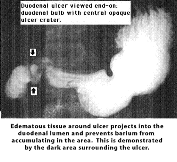 Ulcus (forts.): Symtom - Symtom vid ulcus: a.