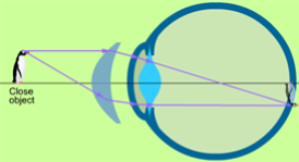 Närsynthet Myopi, eller närsynthet, uppkommer då linsens brytningsförmåga är för stor eller då ögat är för långt. Ljuset bryts så att bilden uppstår framför näthinnan i stället för på den.