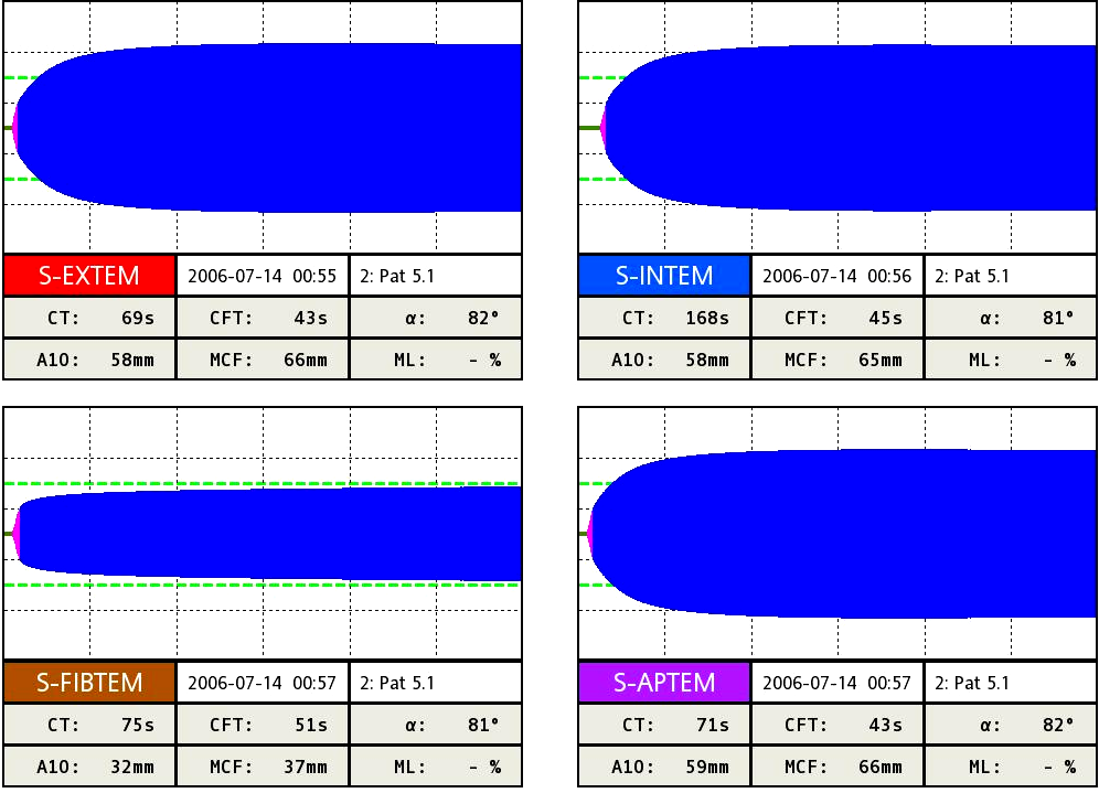 Patientfall Patient med känd trombocytopeni INTEM & EXTEM Normalt FIBTEM Högt MCF Behandling: