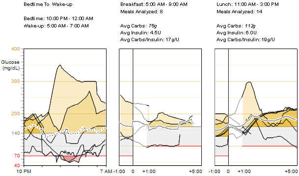 Överlappande sensorglukoskurva från sänggående till uppvaknande samt vid måltidsperioder avläsningar och genomsnitt Från sänggående till uppvaknande I kurvan kombineras sensorglukoskurvan som