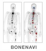 Automated Bone Scan Index Automatic lesion detection and classification based on ANN Automatic