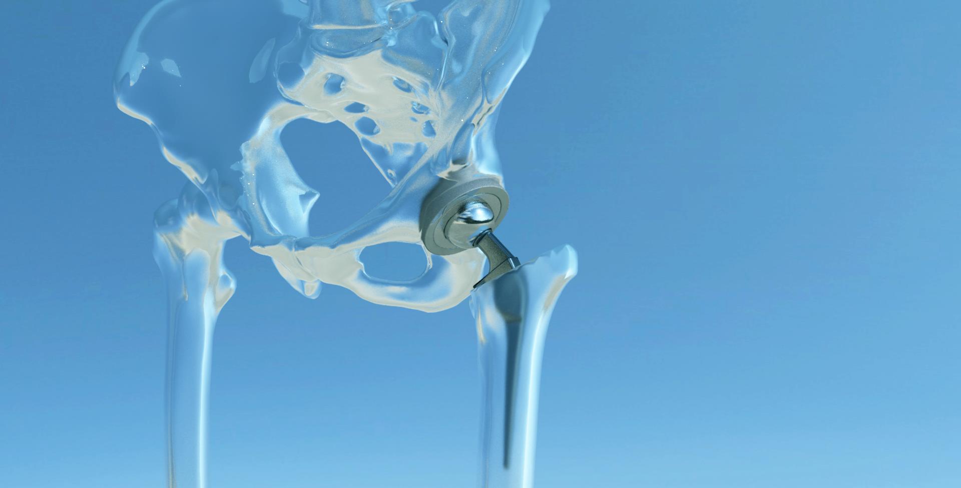 The new generation of joint replacement surgery Rätt implantat, på rätt plats, i varje patient.