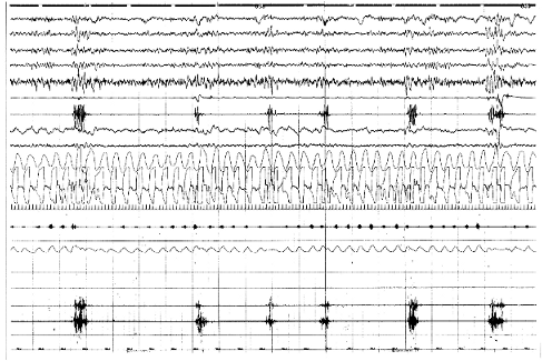 Differentialdiagnos Vid primär sjukdomsform finns som nämnts ofta en ärftlighet och således kunskap i släkten, vilket underlättar diagnosen.