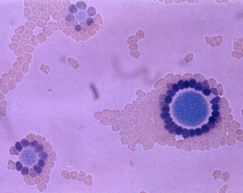 Mycoplasma genitalium Knäckefall och resistensproblematik Carin Anagrius, Britta