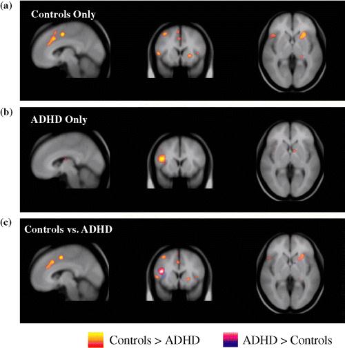 n=2300 tvillingstudie AD/HD är vanligare och kraftigare hos män än hos kvinnor. Könsskillnaderna i AD/HD verkar vara genetiskt betingade.