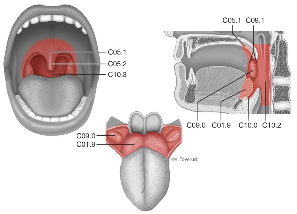 OROFARYNXCANCER 12.9 Orofarynxcancer 12.9.1 Översikt ICD-10 Tonsill C09.0, C09.8, C09.9 Tungbas C01.9 Gombåge C09.1 Mjuka gommens yta mot munhåla C05.1, C05.8, C05.9 Uvula (gomspene) C05.