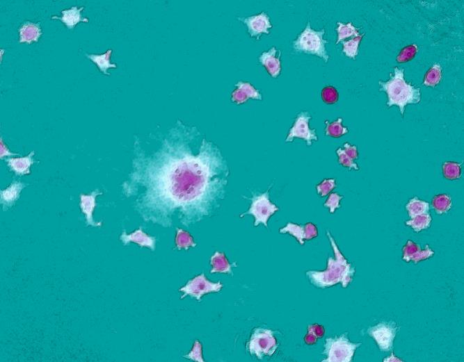 Monstercancercell med flera cellkärnor