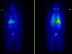 Osteosarkom MR mandibel Osteosarkom skelettscintigrafi T1 T2 Mjukdelskomponent Signalförändring inom höger corpus mandibulae Frågeställning: Utbredning i mandibeln?