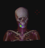 Osteosarkom skelettscintigrafi fallgrop Helkroppsbild: Ingen spridning SPECT/CT: Lokal utbredning 24-tim planar helkroppsbild Anterior MIBG-scintigrafi Posterior MIBG