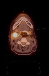 FDG PET för behandlingskontroll 16-årig man Hodgkin lymfom Normal 8 april 27 maj under behandling med cytostika MIP Fusionsbild Tonsillcancer