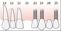 110 (137) 6.7.6.1.1 Exempel, en implantatkrona utförs, åtgärd 850 En patient har en befintlig implantatstödd sektionsbro i tandposition 22 25 samt egna tänder i tandposition 17 21.