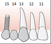 Tandläkaren föreslår ett implantat med implantatkrona i tandposition 21 med tvåstegskirurgi.