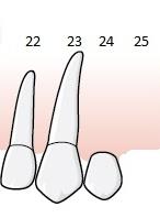 11 gäller för partiellt tandlösa käkar. Regel E.