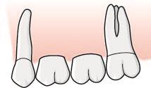 Tandstödd protetik 6.5.1 Allmänt om tandstödd protetik Behandling med tandstödd protetik är ersättningsberättigande för tandluckor inom tandposition 6 6.