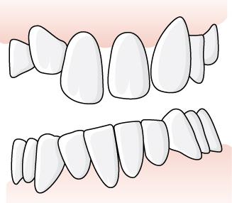 87 (137) 6.5.3.3.1 Exempel, korrektion av ocklusionplan beroende på elongerad tand En patient har en tvåtandslucka i tandposition 34 och 35 och behöver fler tuggkontakter.